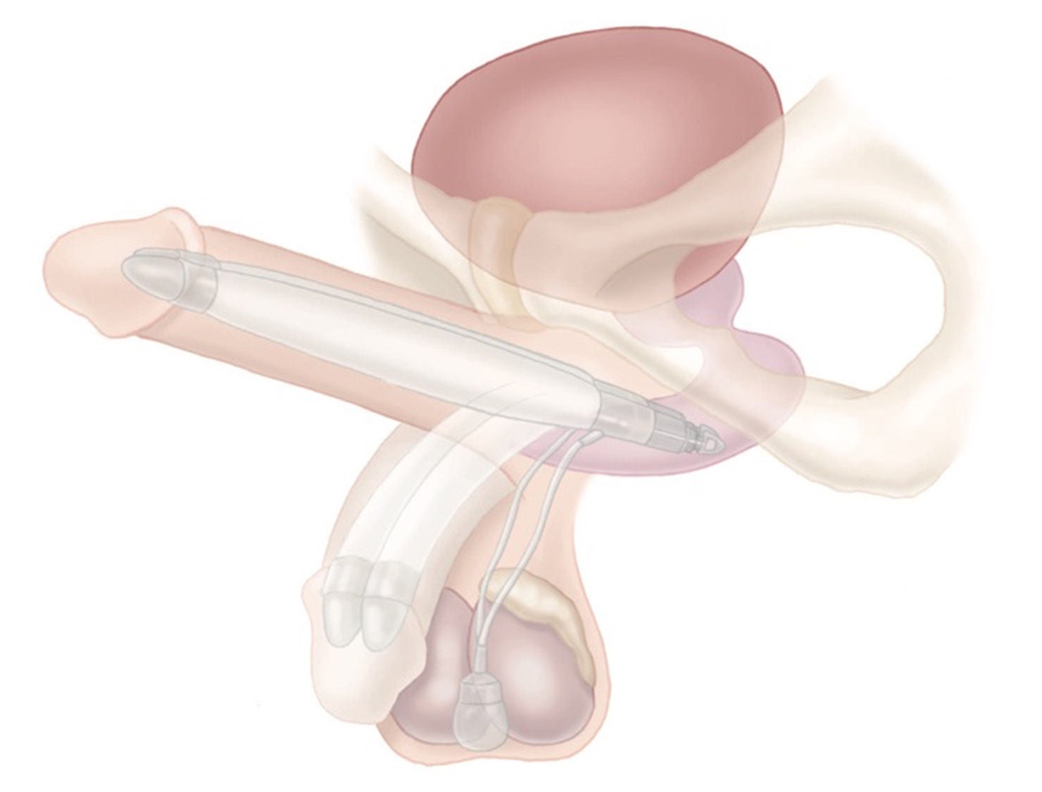 AMS Ambicor™ Penile Implant illustration.