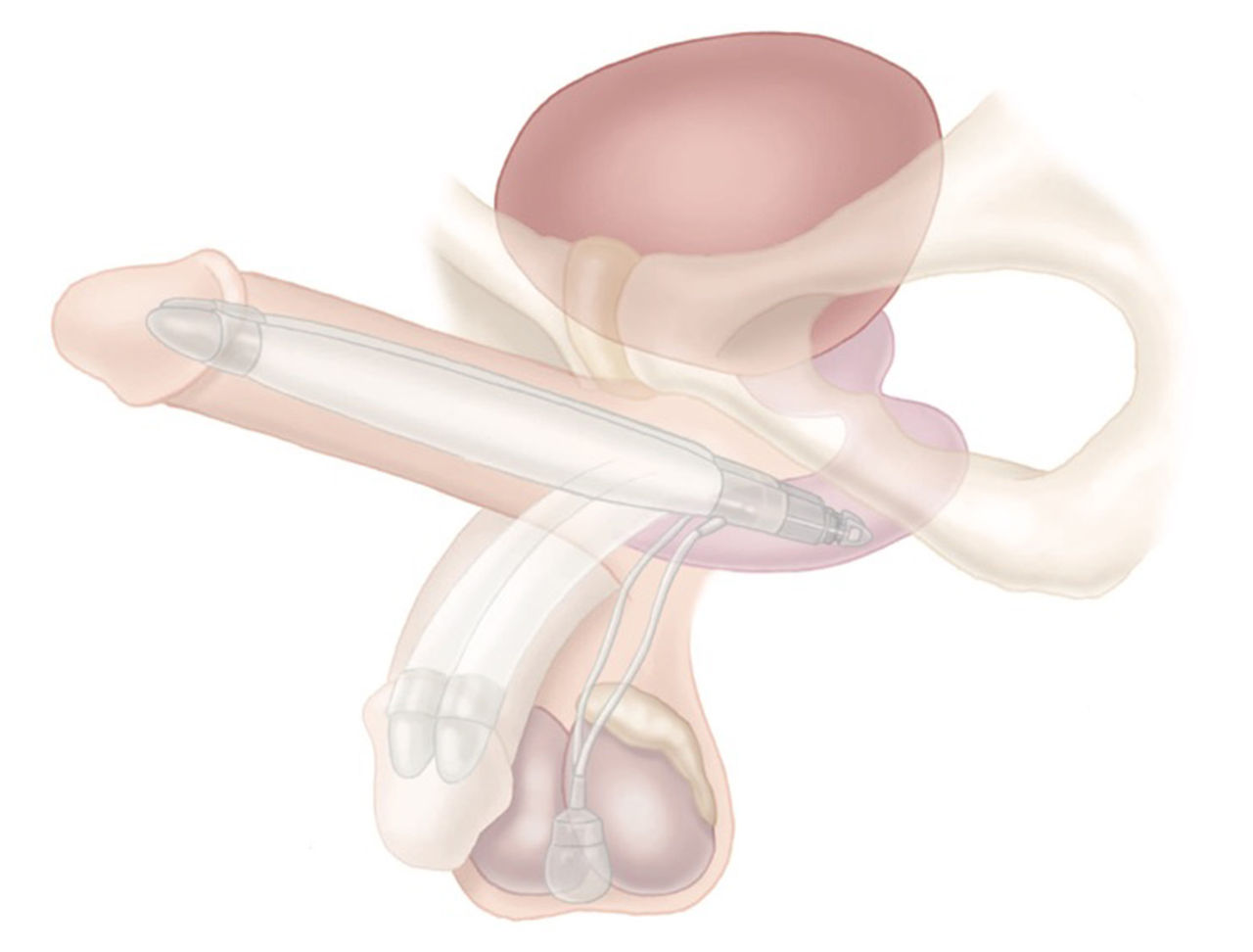 AMS Ambicor™ Penile Implant illustration.